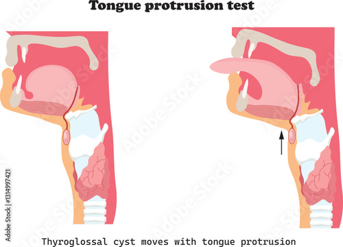 The tongue protrusion test is a simple clinical examination used to assess the function of the hypoglossal nerve and thyroglossal cyst movement