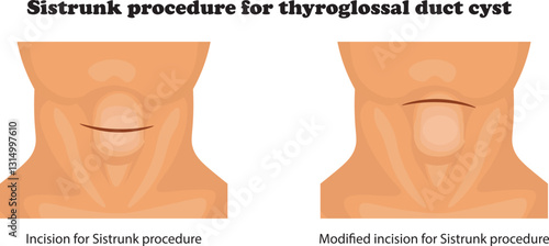 The Sistrunk procedure is a surgical technique used to remove a thyroglossal duct cyst, a common congenital neck mass.