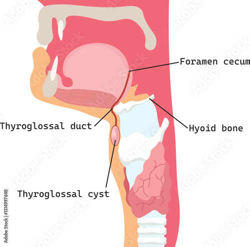 thyroglossal cyst is a mass resulting from a persistent thyroglossal duct, located in the midline of the neck, painless, fluctuant swelling that move with swallowing or tongue protrusion