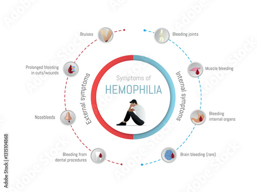 Hemophilia symptoms showing internal and external bleeding problems
