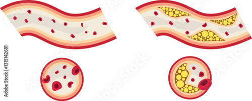 Atherosclerosis is a progressive condition where plaque, composed of fat, cholesterol, calcium, and other substance, builds up inside the arteries, leading to narrowing and reduced blood flow