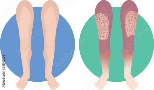 Leriche syndrome gross, with triad of claudication of the buttocks or thighs, diminished femoral pulses, and erectile dysfunction in males
