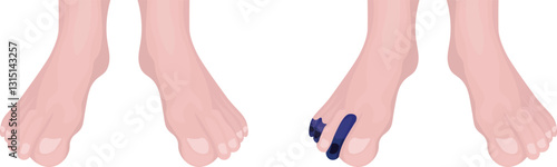 Blue Toe Syndrome is a vascular condition marked by the sudden onset of painful, blue or purple discoloration in one or more toes, caused by decreased blood flow to the periphery