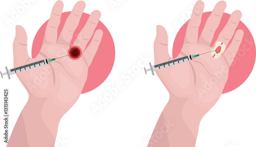 Trigger finger where a finger gets stuck in a bent position and then suddenly snaps straight, resembling the action of pulling a trigger due to inflammation or narrowing of the surrounding sheath 