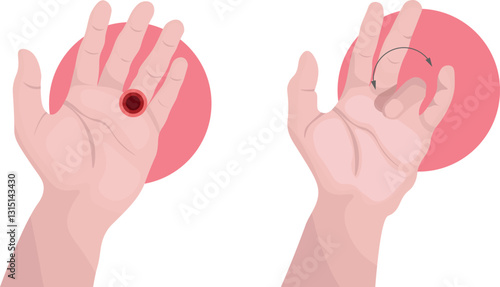 Trigger finger where a finger gets stuck in a bent position and then suddenly snaps straight, resembling the action of pulling a trigger due to inflammation or narrowing of the surrounding sheath 