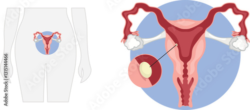 Uterine implantation in normal pregnancy where a fertilized egg attaches to the lining of the uterus which allows the embryo to receive nutrients