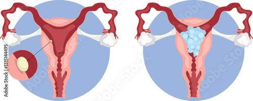 Molar pregnancy, also known as a hydatidiform mole, is a rare complication of pregnancy characterized by the abnormal growth of trophoblastic tissue inside the uterus.