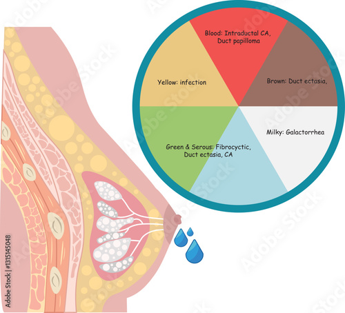 Nipple discharge refers to any fluid that leaks from the nipple of the breast, which can range from normal physiological secretions to signs of underlying medical isssue