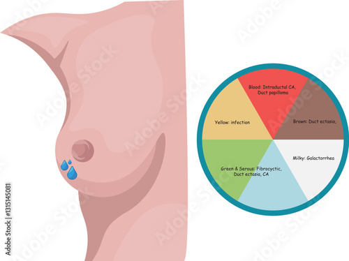 Nipple discharge refers to any fluid that leaks from the nipple of the breast, which can range from normal physiological secretions to signs of underlying medical isssue