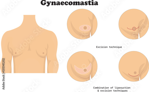 Gynecomastia is a medical condition characterized by the benign enlargement of male breast tissue, often resulting from hormonal imbalances, certain medications, or underlying health conditions