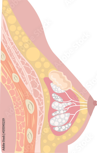 A galactocele is a benign milk-filled cyst that typically forms in the breast during or shortly after lactation. It results from obstruction of a milk duct, leading to the accumulation of milk or milk