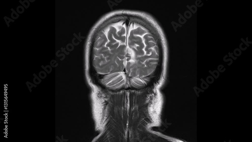 coronal view T2-weighted magnetic resonance imaging (MRI) scan of a normal brain.