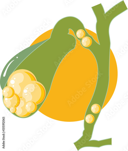 Cholecystitis, gallbladder, gallstones, biliary tree, vector art