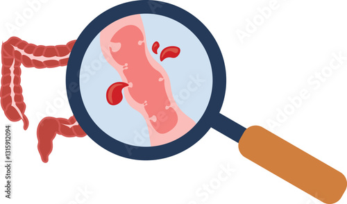 colonic polyp, lower gastrointestinal bleeding, diverticulitis, 