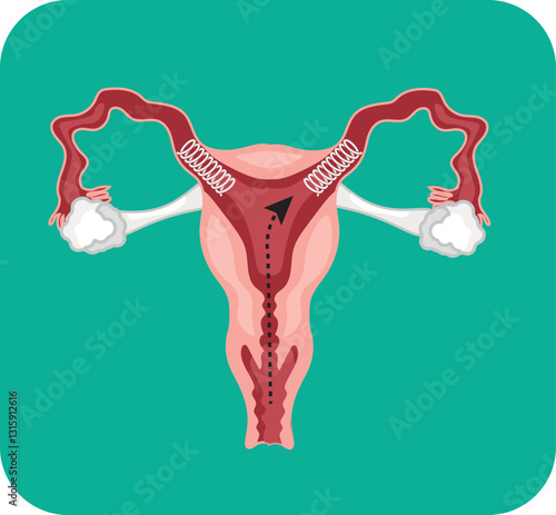 essure micro insert for permanent birth control