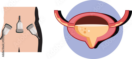 kidney-ureter-bladder ultrasound for residual urine volume post micturition 