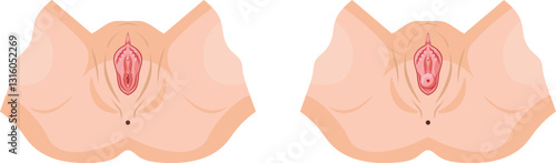 normal genital compared to genital with uterine prolapse
