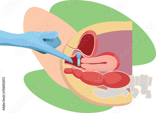 pessary insertion for prevention of uterine prolapse