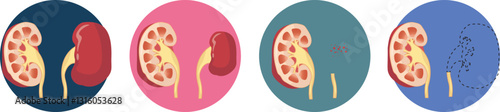 most common congenital renal malformation