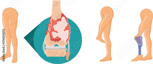 Rotationplasty surgery for bone tumor 