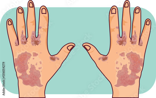 scabies on the finger and dorsal of the hands
