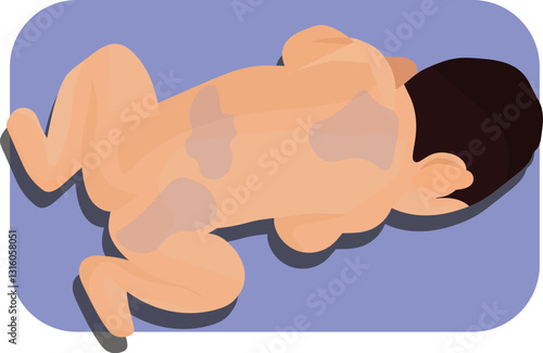 mongolian blue spot birthmarks at the back side of the baby 
