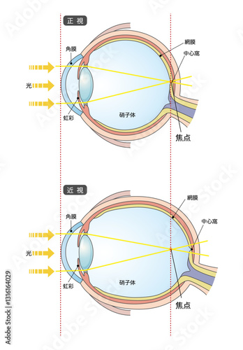正常な眼球と軸性近視の眼球