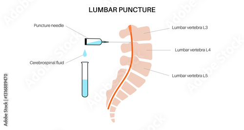 Lumbar puncture spinal tap