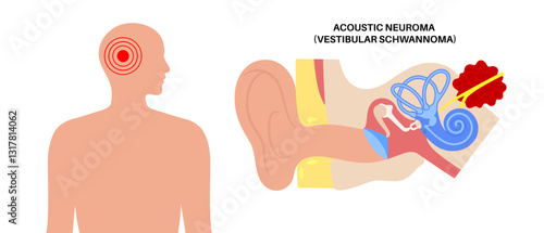 Acoustic neuroma poster