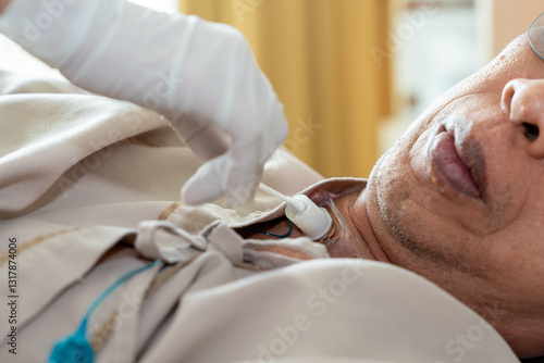 Hands of nurse clean the tracheostomy tube with cotton. Patients who have undergone a tracheostomy for intubation in hospital