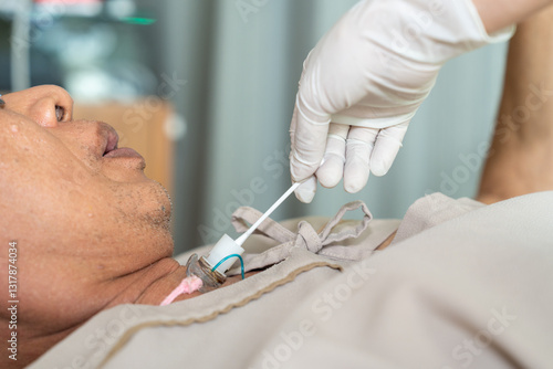 Hands of nurse clean the tracheostomy tube with cotton. Patients who have undergone a tracheostomy for intubation in hospital