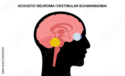 Acoustic neuroma poster