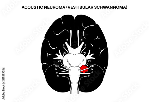 Acoustic neuroma poster