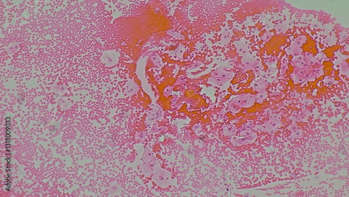 Human cervical squamous epithelial cells under microscope view. Pap smear test a procedure to test for cervical cancer in women.