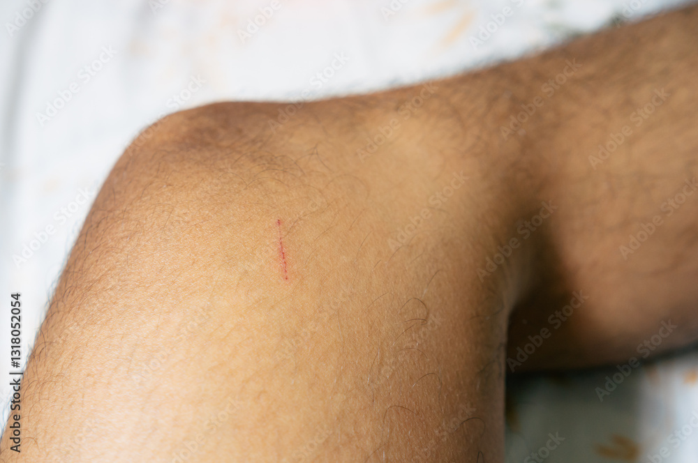 Naklejka premium The skin on the feet is injured due to scratches