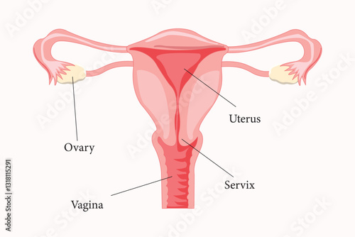 Medical illustration of the female reproductive system with labeled uterus, ovary, cervix, and vagina