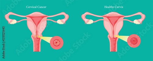 Cervical cancer awareness infographic showing healthy and diseased cervix.