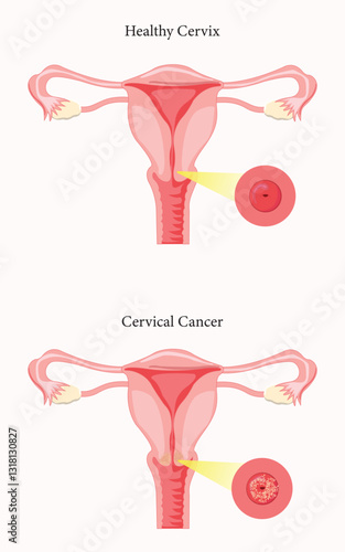 Visual comparison of a healthy cervix and cervical cancer in the female reproductive system. eps 10