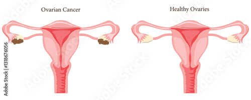 Visual comparison of a healthy cervix and cervical cancer in the female reproductive system