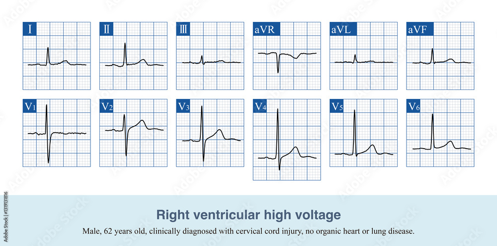 Φωτογραφία When the R wave amplitude of lead V1 in adults exceeds 6mm and there are no organic heart disease or other disease electrocardiogram changes, it is a simple right ventricular high voltage