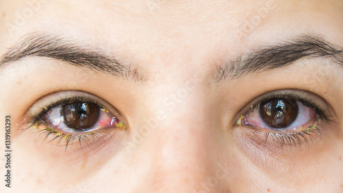 Quadro su tela Close-up of human eyes with conjunctivitis, showing redness, irritation, and yellow discharge