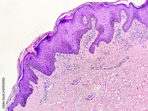 Fotografía Photomicrograph showing keratosis of the Skin, hematoxylin eosin staining, Microscopic view in pathology laboratory