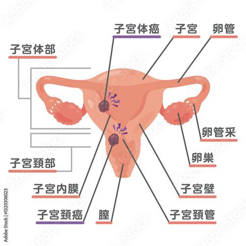 癌ができた卵巣と子宮のイラスト1