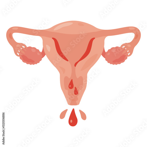 出血を起こす子宮のイラスト