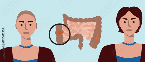 Cancer patients silhouettes and cancer ribbon, silhouette vector stock illustration with unidentifiable people together as a template with space for text or copy space