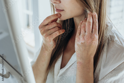 Skin problem, acne, psoriasis. Women's hands with red skin, itching.