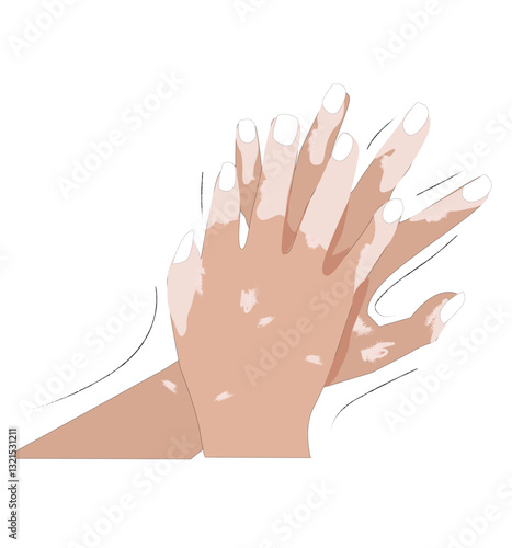 skin hands with vitiligo depigmantation 