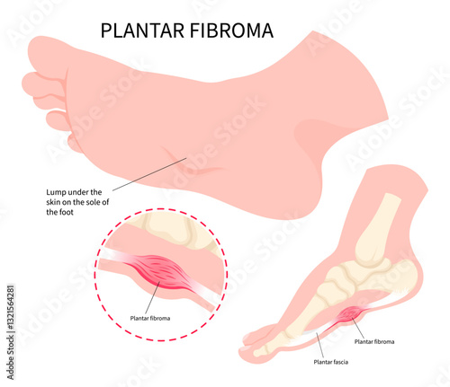 Anatomy of Dupuytren’s Plantar Fibromas disease on the arch of foot that causes pain