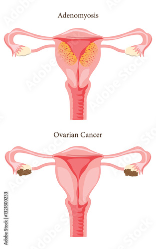 Gynecological Health: Adenomyosis vs. Ovarian Cancer Infographic