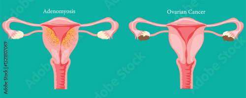 Medical Illustration of Adenomyosis and Ovarian Cancer in Female Reproductive System